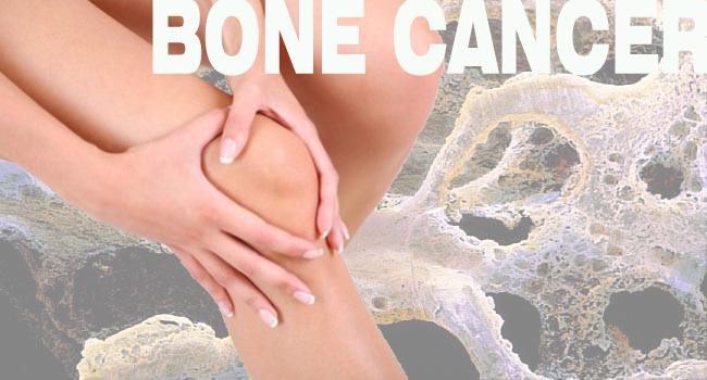 Bone Cancer: Symptoms, Treatment and Types